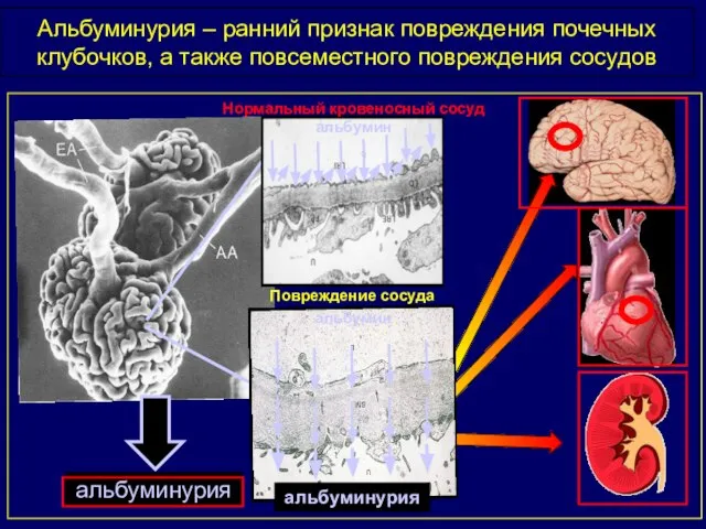 Альбуминурия – ранний признак повреждения почечных клубочков, а также повсеместного повреждения