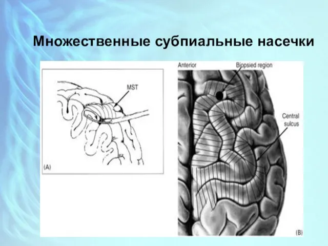 Множественные субпиальные насечки