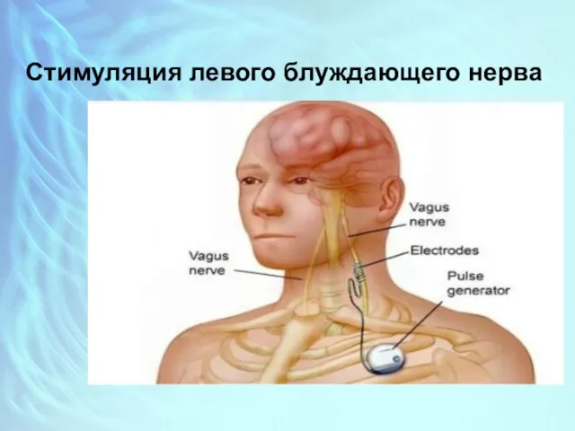 Стимуляция левого блуждающего нерва