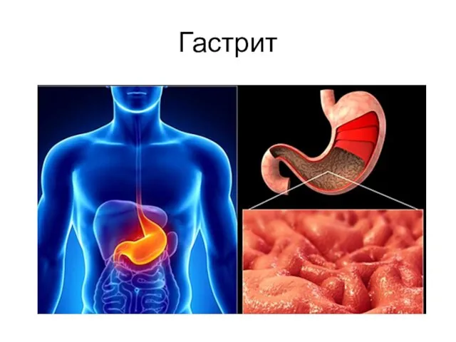 Гастрит