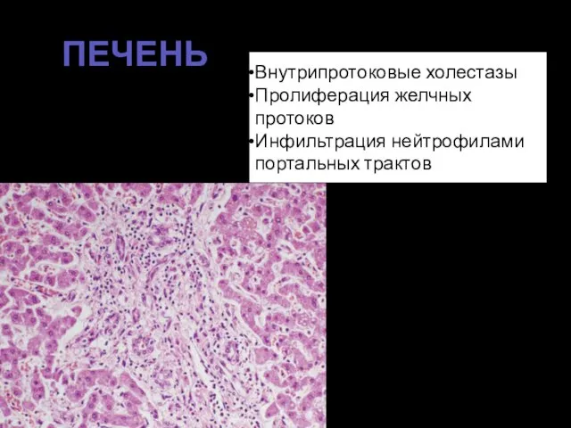 ПЕЧЕНЬ Внутрипротоковые холестазы Пролиферация желчных протоков Инфильтрация нейтрофилами портальных трактов