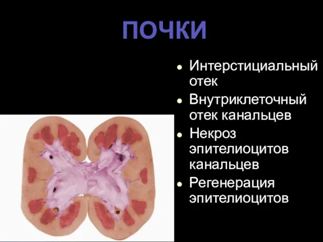 ПОЧКИ Интерстициальный отек Внутриклеточный отек канальцев Некроз эпителиоцитов канальцев Регенерация эпителиоцитов