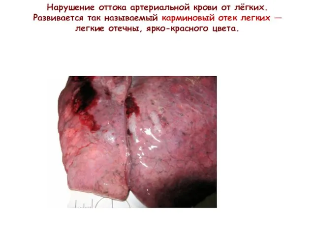Нарушение оттока артериальной крови от лёгких. Развивается так называемый карминовый отек
