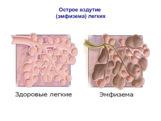 Острое вздутие (эмфизема) легких