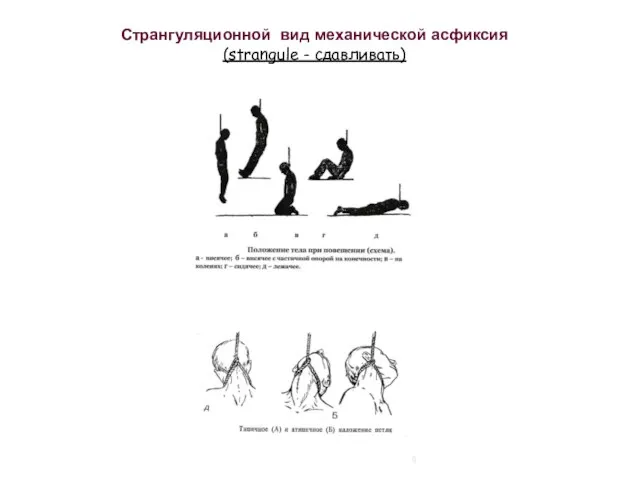 Странгуляционной вид механической асфиксия (strangule - сдавливать)