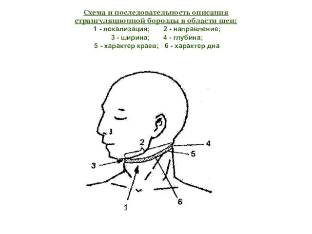 Схема и последовательность описания странгуляционной борозды в области шеи: 1 -