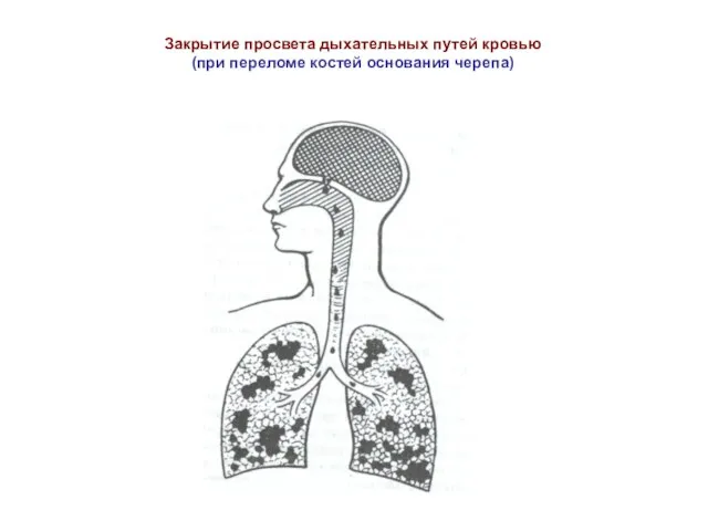 Закрытие просвета дыхательных путей кровью (при переломе костей основания черепа)