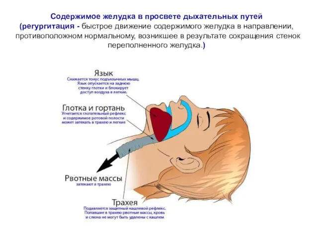 Содержимое желудка в просвете дыхательных путей (регургитация - быстрое движение содержимого