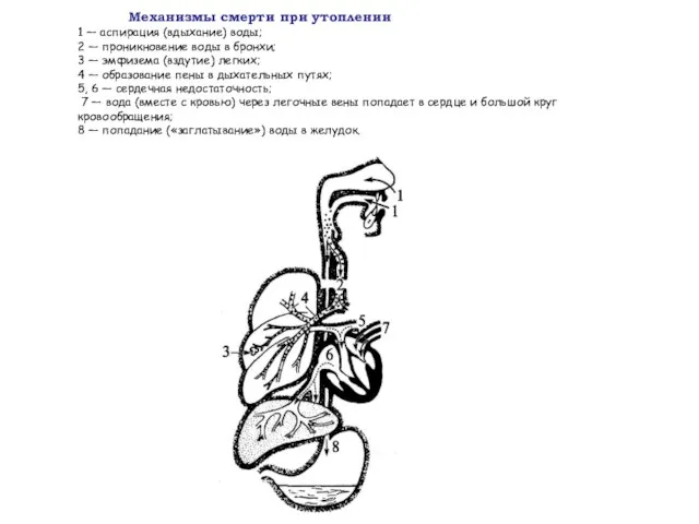 Механизмы смерти при утоплении 1 — аспирация (вдыхание) воды; 2 —