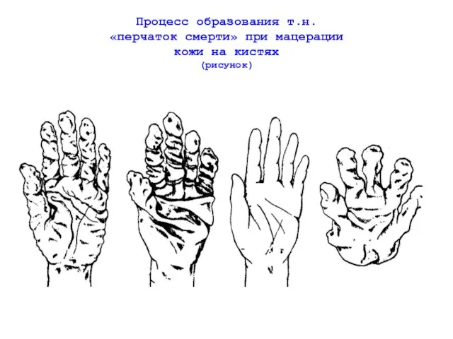 Процесс образования т.н. «перчаток смерти» при мацерации кожи на кистях (рисунок)