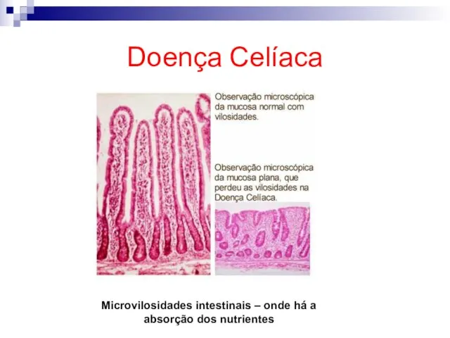 Doença Celíaca Microvilosidades intestinais – onde há a absorção dos nutrientes