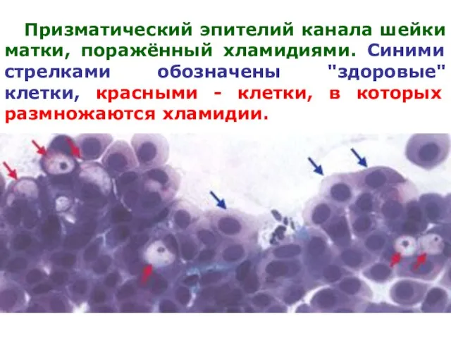 Призматический эпителий канала шейки матки, поражённый хламидиями. Синими стрелками обозначены "здоровые"