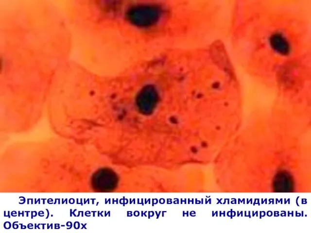 Эпителиоцит, инфицированный хламидиями (в центре). Клетки вокруг не инфицированы. Объектив-90х