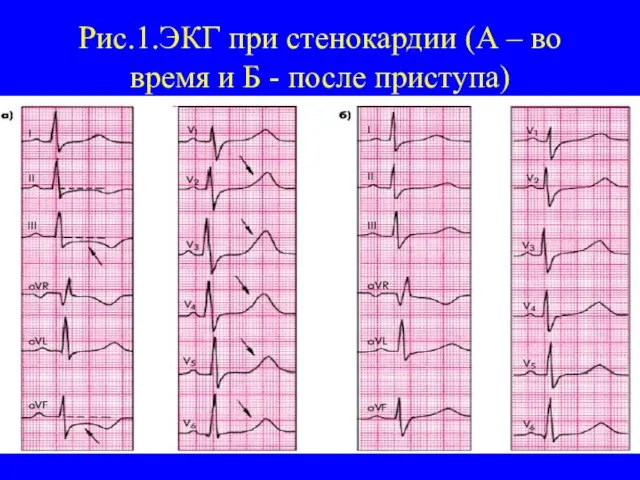 Рис.1.ЭКГ при стенокардии (А – во время и Б - после приступа)