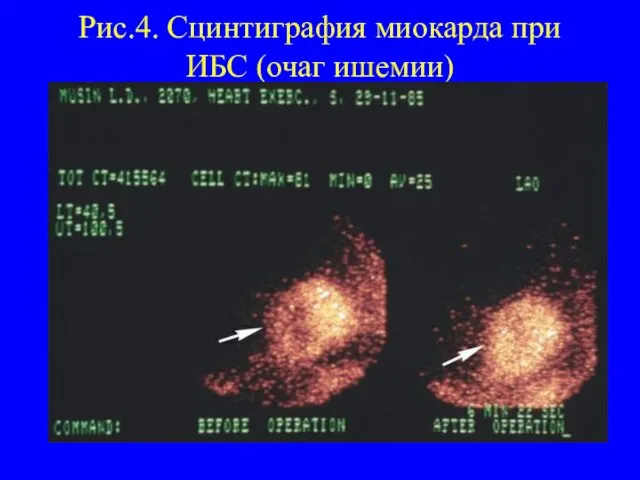 Рис.4. Сцинтиграфия миокарда при ИБС (очаг ишемии)