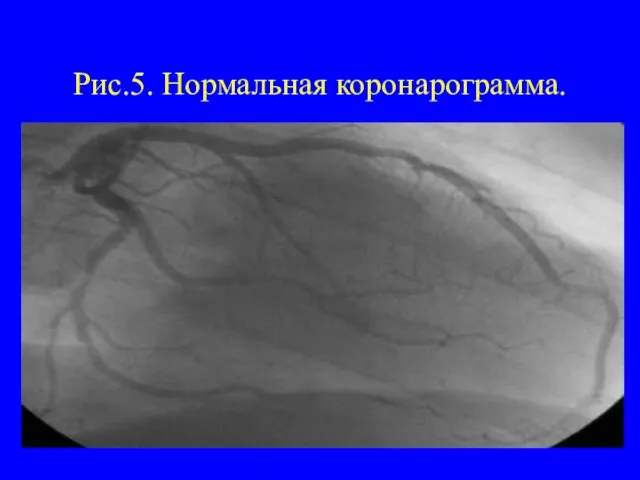 Рис.5. Нормальная коронарограмма.