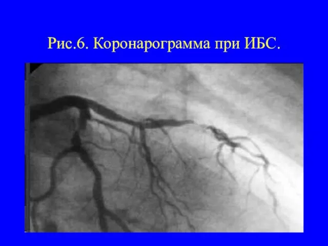 Рис.6. Коронарограмма при ИБС.