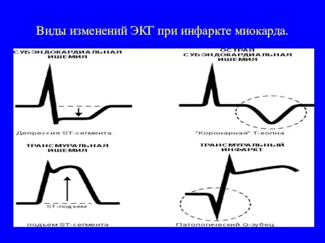 Виды изменений ЭКГ при инфаркте миокарда.