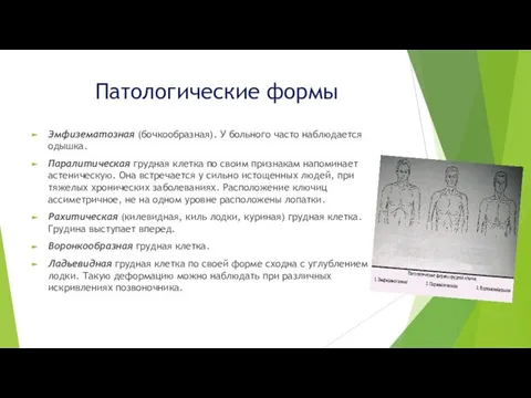 Патологические формы Эмфизематозная (бочкообразная). У больного часто наблюдается одышка. Паралитическая грудная