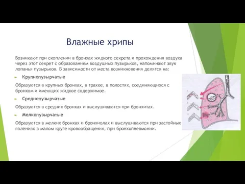 Влажные хрипы Возникают при скоплении в бронхах жидкого секрета и прохождения