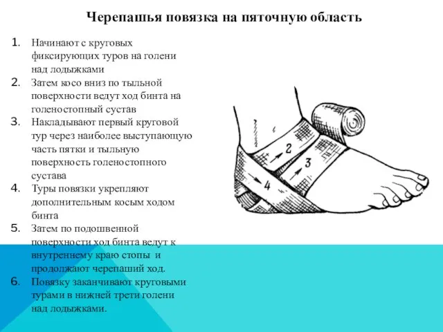 Черепашья повязка на пяточную область Начинают с круговых фиксирующих туров на