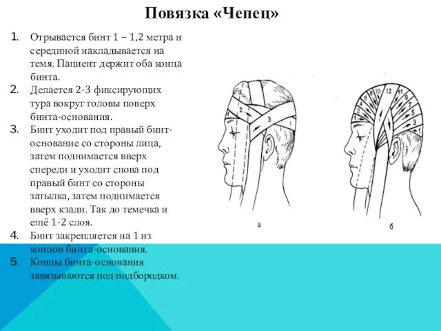 Повязка «Чепец» Отрывается бинт 1 – 1,2 метра и серединой накладывается