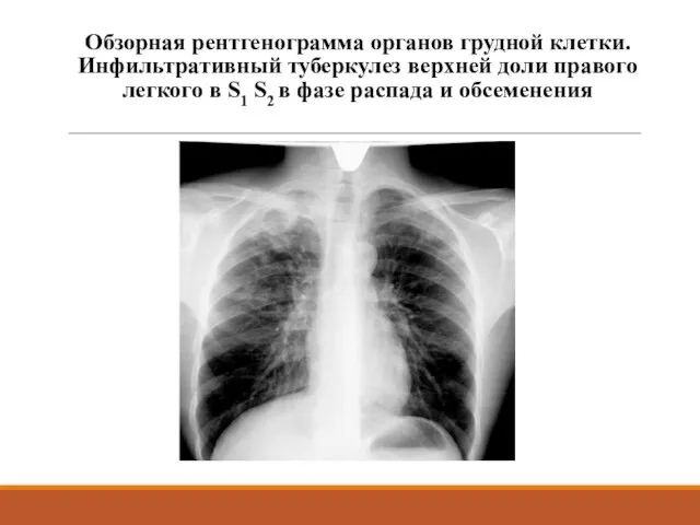 Обзорная рентгенограмма органов грудной клетки. Инфильтративный туберкулез верхней доли правого легкого