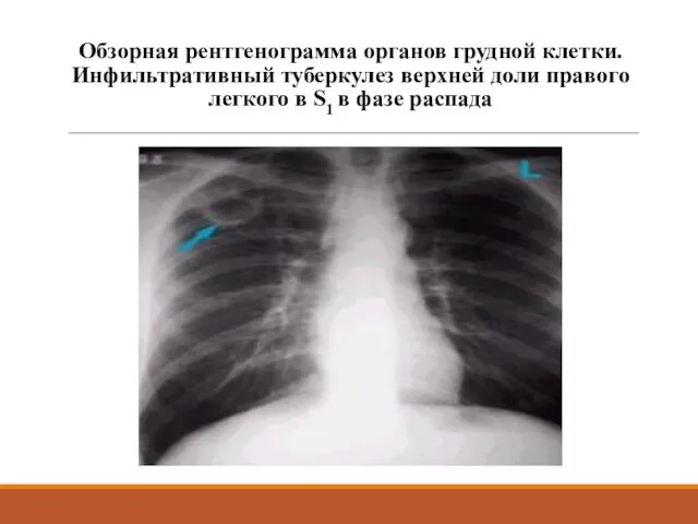 Обзорная рентгенограмма органов грудной клетки. Инфильтративный туберкулез верхней доли правого легкого в S1 в фазе распада