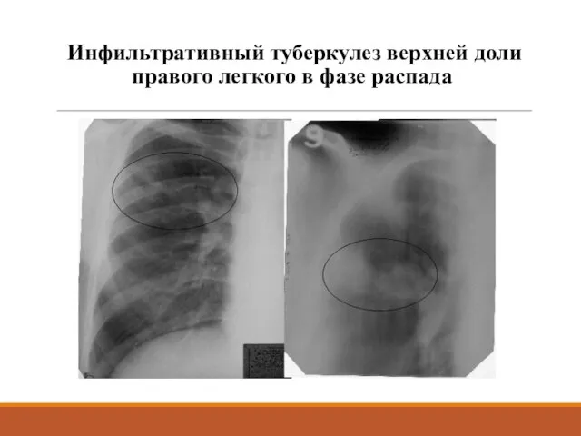 Инфильтративный туберкулез верхней доли правого легкого в фазе распада