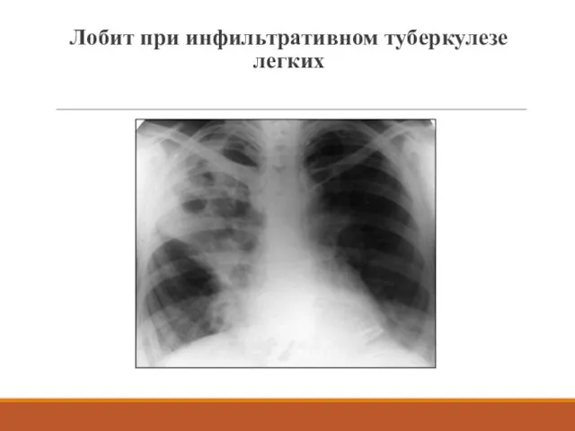 Лобит при инфильтративном туберкулезе легких