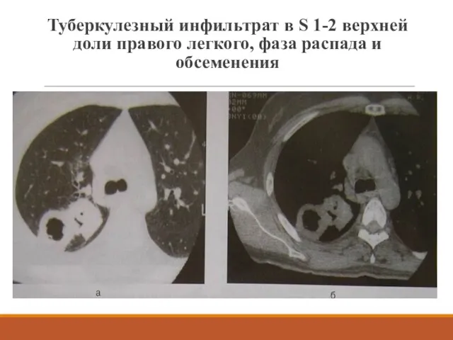 Туберкулезный инфильтрат в S 1-2 верхней доли правого легкого, фаза распада и обсеменения