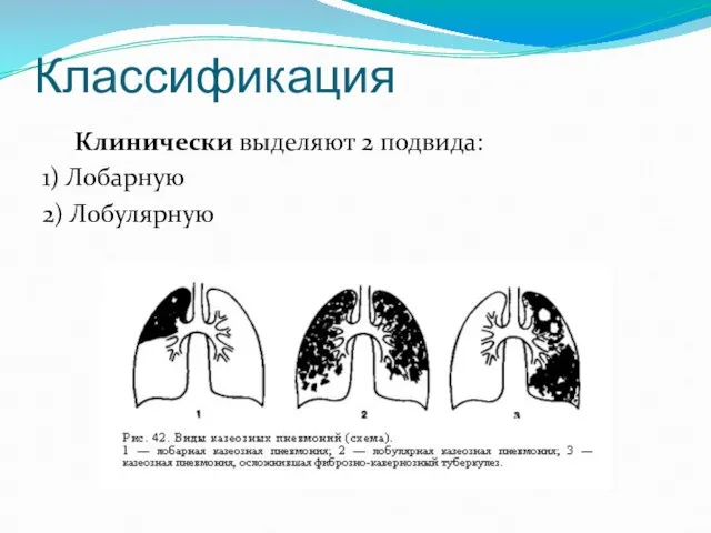 Классификация Клинически выделяют 2 подвида: 1) Лобарную 2) Лобулярную