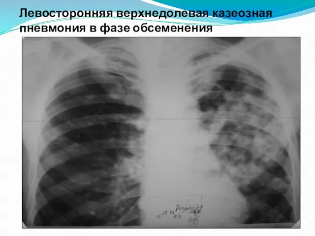 Левосторонняя верхнедолевая казеозная пневмония в фазе обсеменения