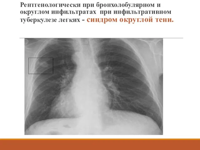 Рентгенологически при бронхолобулярном и округлом инфильтратах при инфильтративном туберкулезе легких - синдром округлой тени.