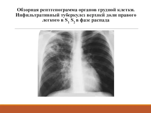 Обзорная рентгенограмма органов грудной клетки. Инфильтративный туберкулез верхней доли правого легкого