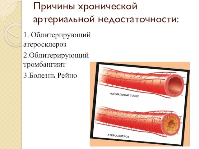 Причины хронической артериальной недостаточности: 1. Облитерирующий атеросклероз 2.Облитерирующий тромбангиит 3.Болезнь Рейно