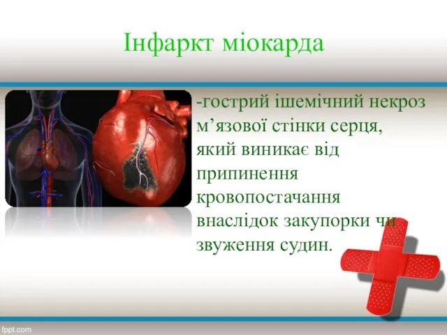 Інфаркт міокарда -гострий ішемічний некроз м’язової стінки серця, який виникає від