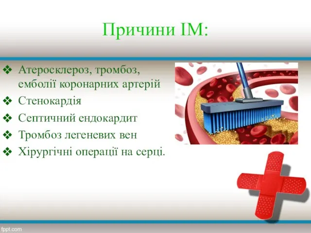 Причини ІМ: Атеросклероз, тромбоз, емболії коронарних артерій Стенокардія Септичний ендокардит Тромбоз