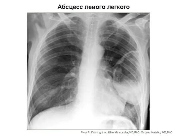 Абсцесс левого легкого Риту Р., Гилл, д.м.н., Шин Matsusoka,MD,PhD, Хирато Hatabu, MD,PhD