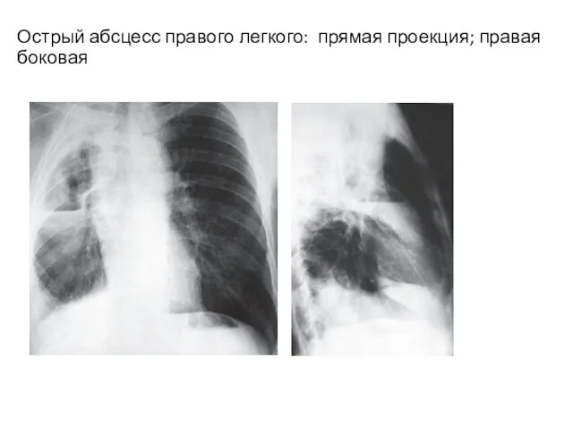 Острый абсцесс правого легкого: прямая проекция; правая боковая