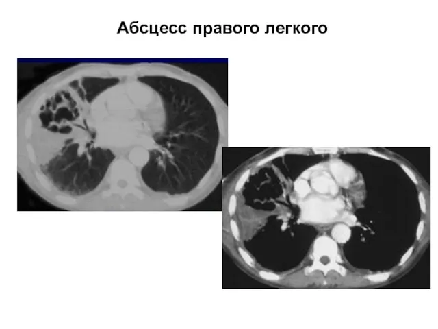 Абсцесс правого легкого