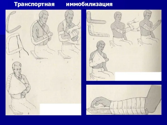 Транспортная иммобилизация