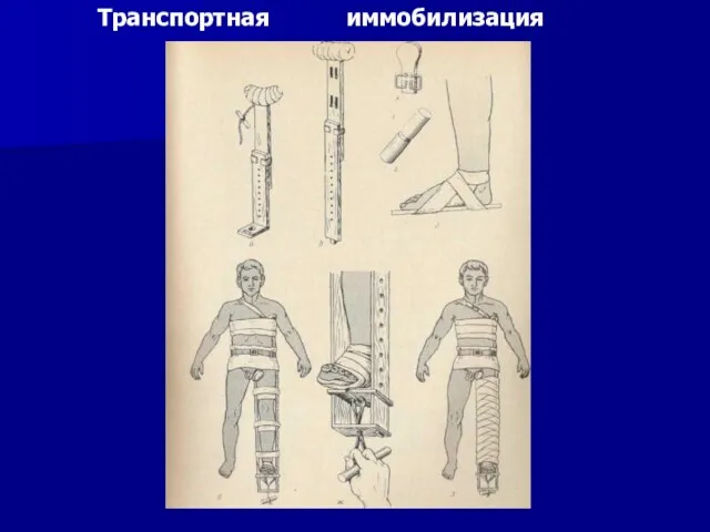 Транспортная иммобилизация