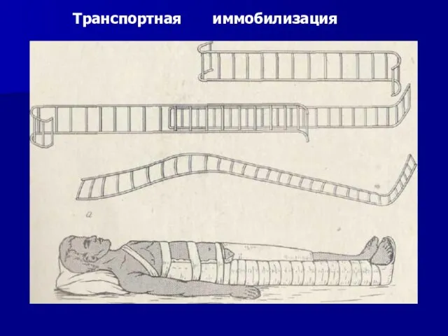 Транспортная иммобилизация