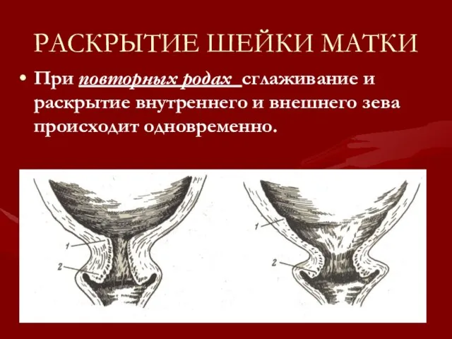 РАСКРЫТИЕ ШЕЙКИ МАТКИ При повторных родах сглаживание и раскрытие внутреннего и внешнего зева происходит одновременно.