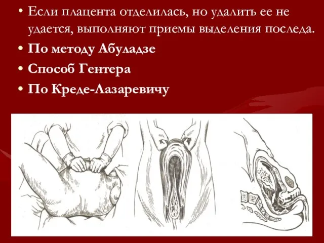 Если плацента отделилась, но удалить ее не удается, выполняют приемы выделения