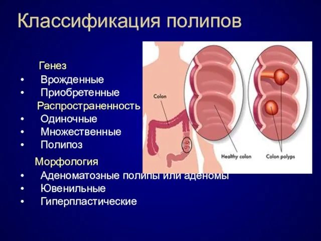 Классификация полипов Генез Врожденные Приобретенные Распространенность Одиночные Множественные Полипоз Морфология Аденоматозные полипы или аденомы Ювенильные Гиперпластические