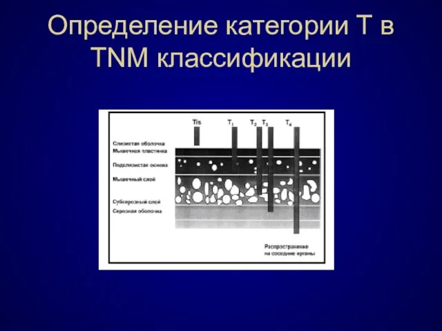 Определение категории Т в TNM классификации