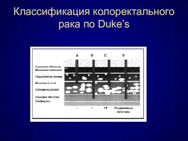 Классификация колоректального рака по Duke’s