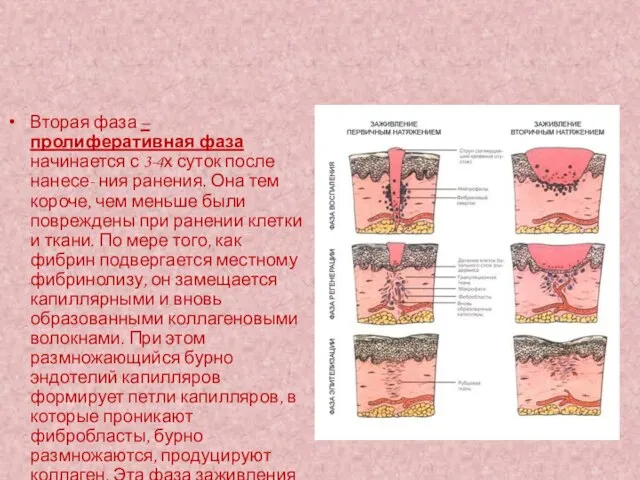 Вторая фаза – пролиферативная фаза начинается с 3-4х суток после нанесе-